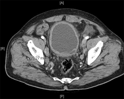 Abdominal pelvic computed tomography (CT) scan: lymphad | Open-i