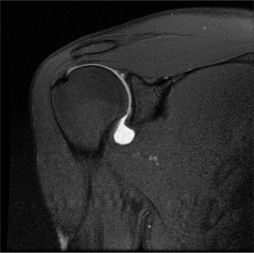 Coronal MRI image of the shoulder showing extravasation Openi