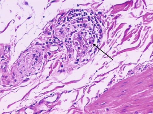 Submucosal plexus showing inflammatory infiltrate; some | Open-i