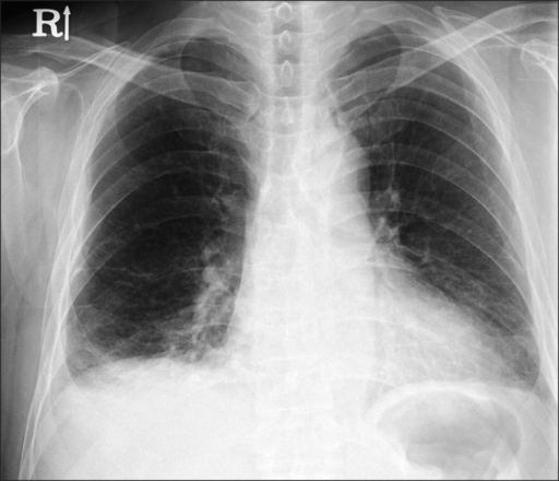 Chest x-ray shows ill-defined density in the right lowe | Open-i