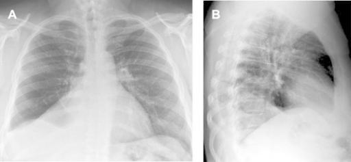 Chest Radiograph Shows Right Lower Lobe (rll) Collapse, 