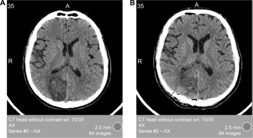 Computed Tomography Ct Scan Of The Head Without Contr Open I