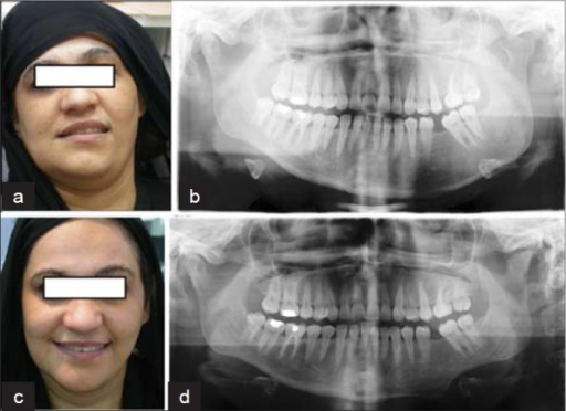 Cirugía sobre la asimetría mandibular Cirugía sobre la asimetría mandibular