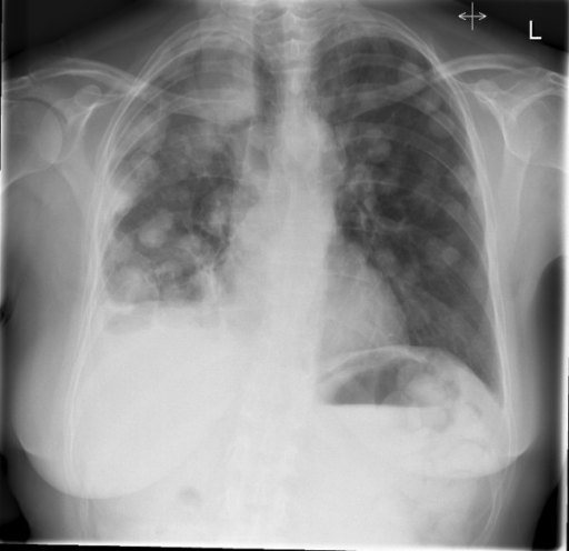 Distant metastasis-PA chest X-ray showing extensive can | Open-i