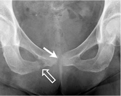 anteroposterior-radiograph-of-the-pelvis-shows-a-fractu-open-i