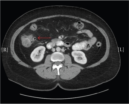 Transverse CT image demonstrating right-sided colonic | Open-i