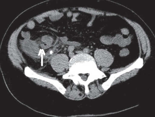 Perforated Appendicitis Plain Ct Scan Shows A Dilated Open I
