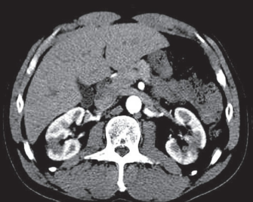 Acute Pyelonephritis Contrast Enhanced Ct Scan Shows E Open I