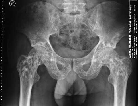 Кт подвздошной кости. Хондроматоз тазобедренного сустава. Метастазы костей таза кт. Рентген подвздошной кости. Олеогранулемы тазобедренного сустава.