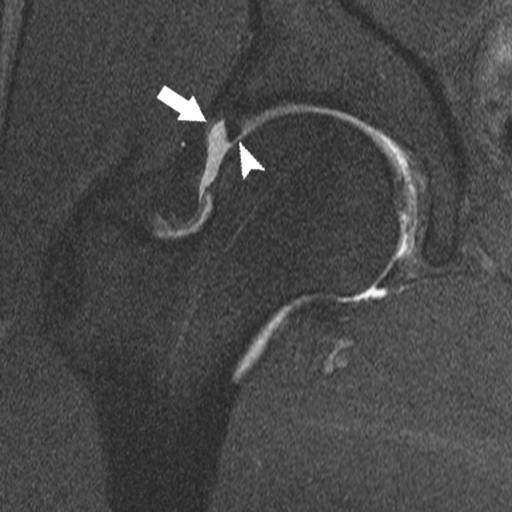 Hip Arthrogram Injection