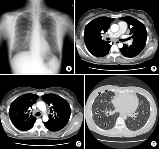 chest-radiography-a-shows-prominent-bronchovascular-m-open-i