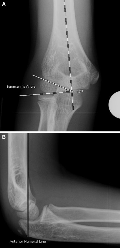 (a) Baumann’s Angle Is Obtained On The Anteroposterio | Open-i