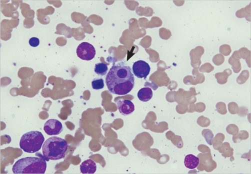 Hemophagocytosis (arrow) on smears of bone marrow aspir | Open-i