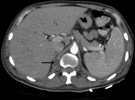 Psoas Abscess Ct Scan