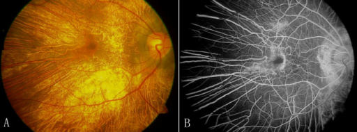Fundus Photographs Of The Right Eye 38 Year Old Choroideremia Affected Fundus Photographs Of The Right Eye 38 Year Old Choroideremia Affected