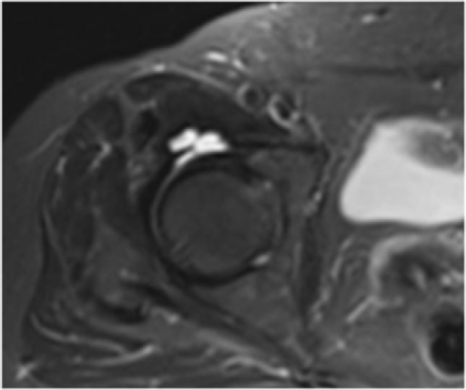 Bursitis and distension of a bursa iliopectinea. | Open-i