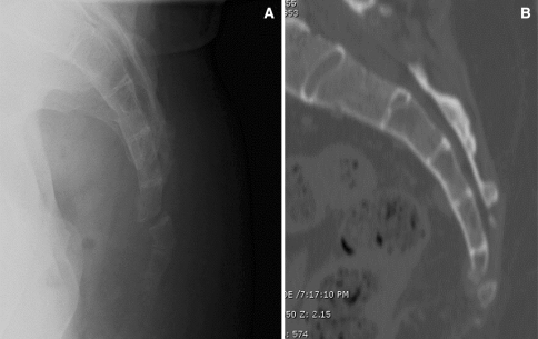 Lateral radiograph (a) and sagittal CT reconstruction ( | Open-i