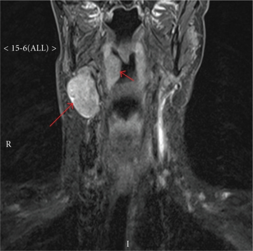 visible-lymph-nodes-in-neck