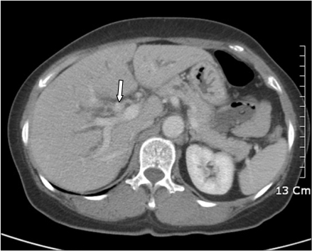 Computed tomograpy shows enhancing mass at confluent le | Open-i