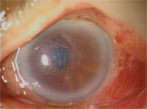 What is corneal edema?