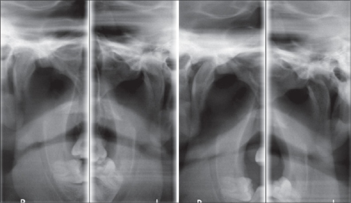 Transcranial radiograph of temporomandibular joint show | Open-i