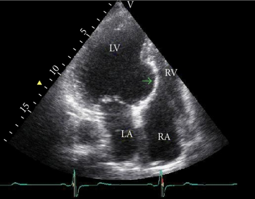 Transthoracic echocardiographic image of left ventricul | Open-i