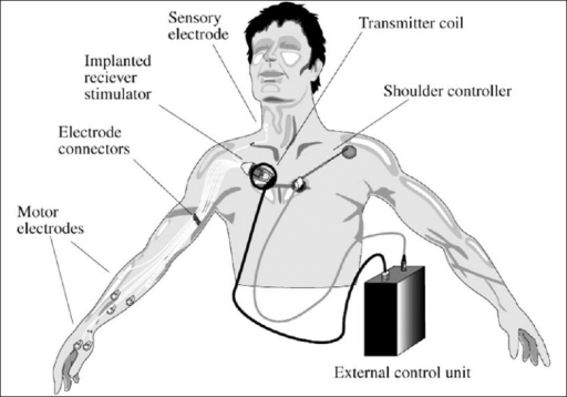 The Freehand system is an implanted system with stimula | Open-i