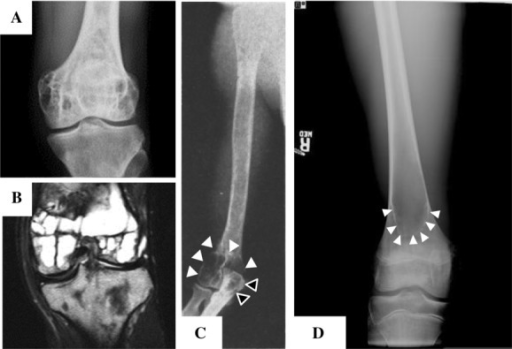 Osteolytic skeletal lesions in CGL and AGL. A B Mu Open i