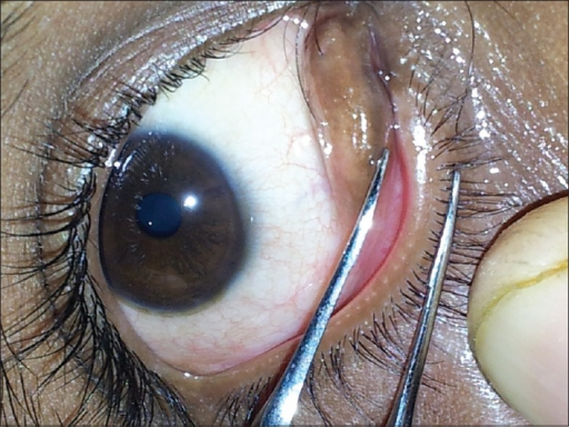 Photograph Showing Right Double Lower Eyelid With A Pse Open I