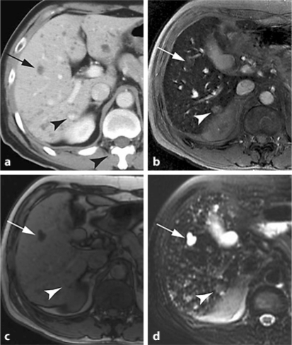 Coexistence Of Multiple Cystic Lesions (arrow) And A Ha | Open-i