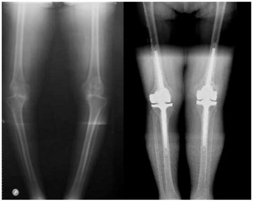 Preoperative X-ray of a patient with a severe bilateral | Open-i