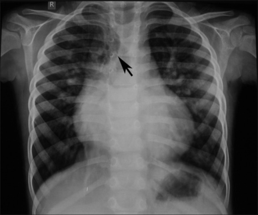 Shadow On Lung X Ray