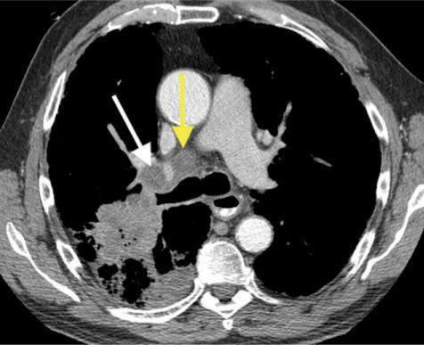 Right upper lobe squamous cell cancer with post-obstruc | Open-i