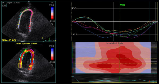 Speckle tracking derived strain in neonates: planes, layers and drift