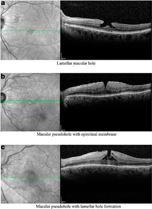 Lamellar macular hole and macular pseudohole a lamel open i