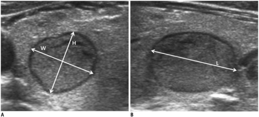 thyroid-nodule-diameters-measured-by-using-ultrasonogra-open-i