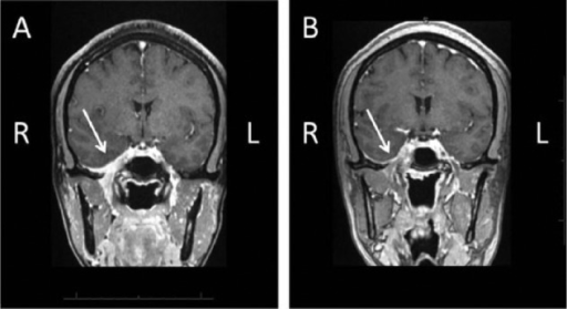 internal auditory canal mri with contrast