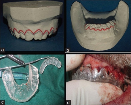 Crown Lengthening Procedure. (a, B): Maxillary And Mand | Open-i