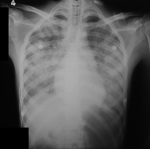 Chest x ray of the patient demonstrating diffuse pulmon | Open-i