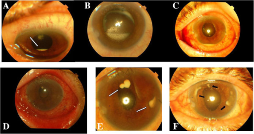 Long-term myofibroblast persistence in the capsular bag contributes to the  late spontaneous in-the-bag intraocular lens dislocation | Scientific  Reports