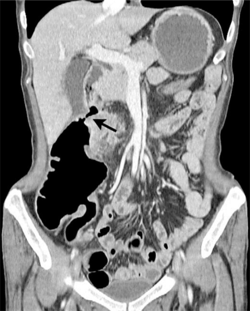 Transverse View Of Ct Scan Abdomen Showing Dilated Duodenum And Images