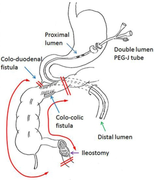 Needle Catheter Jejunostomy Technique at Helen Megan blog