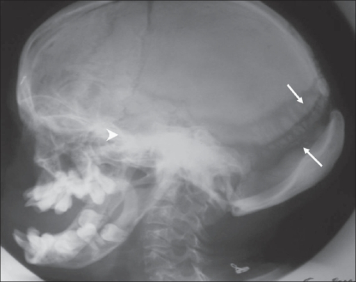 A lateral skull radiograph shows Wormian bones (arrows) | Open-i