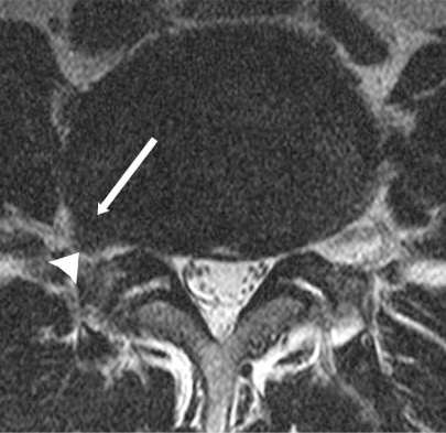 Fifty-five-year-old man with right extraforaminal disc | Open-i