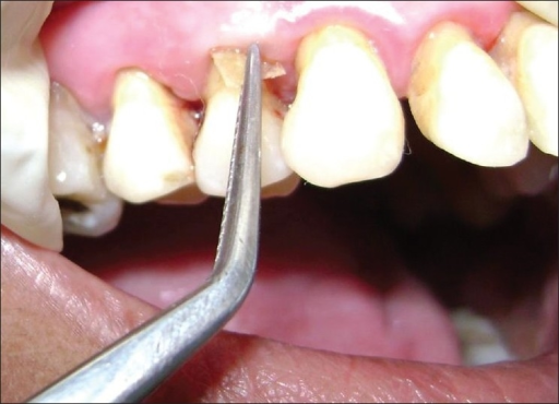 Method of placement of chlorhexidine chip (PerioCol-CG) | Open-i