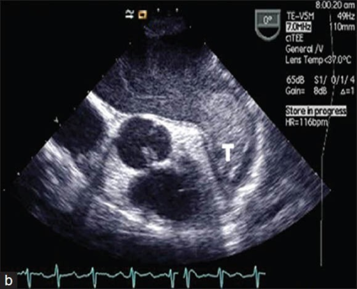 Left Atrial Appendage Echo