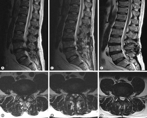 A 64-year-old man with spinal stenosis at L3-L4 and L4- | Open-i