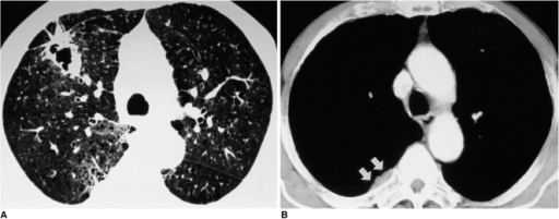 Preoperative chest CT scans in a 67-year-old man with a | Open-i