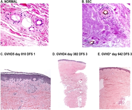 Dermal Fibrosis In Skin Biopsies Of Normal, C-GVHD And | Open-i