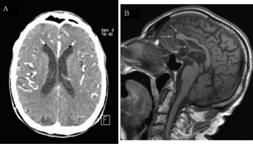 Head CT-scan and MRI image. A. Post contrast head CT-sc | Open-i